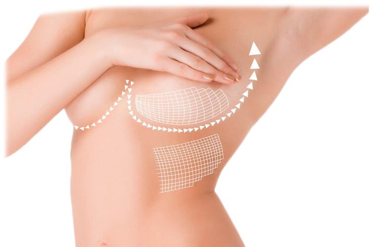 Acción de cápsulas Mammax para o aumento do peito