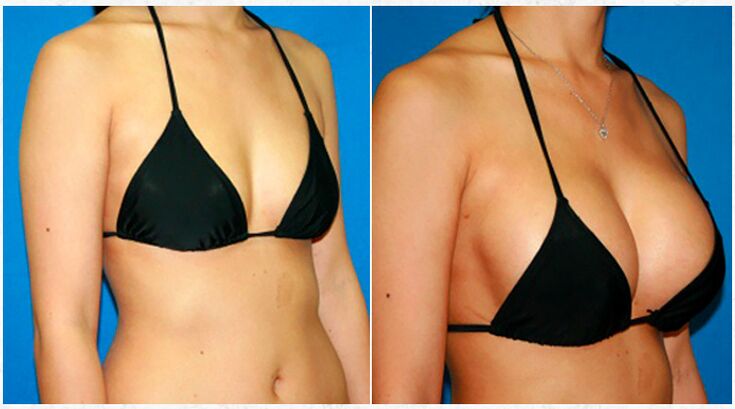 Antes e despois de aumento mamario con cirurxía plástica
