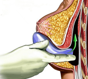 implantación para aumento de mama