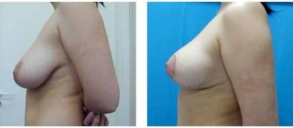 antes e despois do aumento cirúrxico de mama