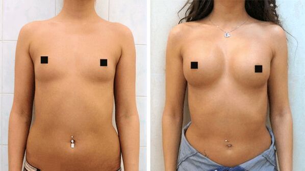 fotos antes e despois do aumento cirúrxico de mama