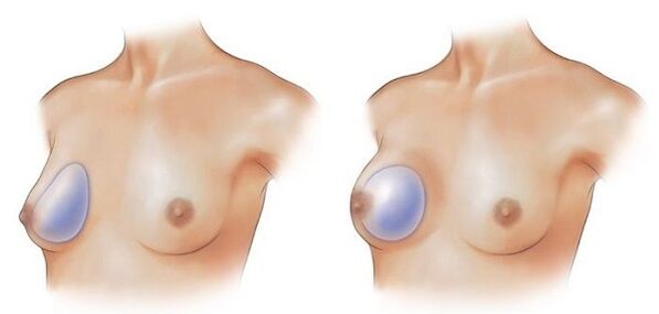 implantes en forma de pinga e redondos para o aumento do peito