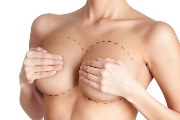 marcador para cirurxía de aumento de mama