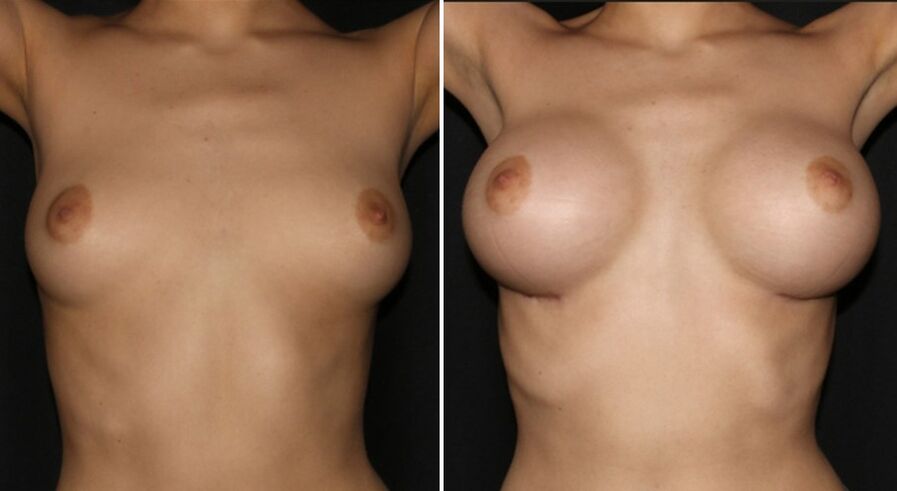Antes e despois da cirurxía de aumento de mama